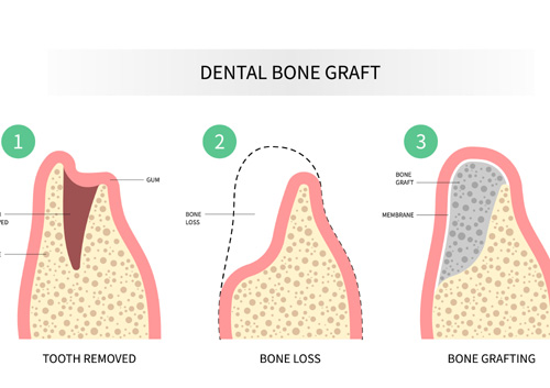 bone graft procedure