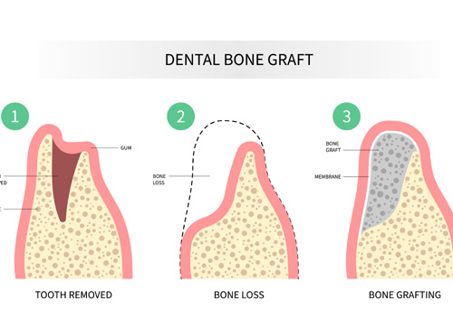 bone graft procedure