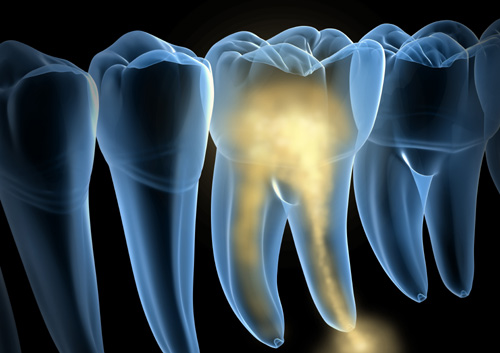 Damaged molar teeth xray view