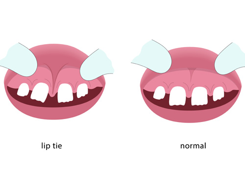 Lip tie illustration before and after surgery