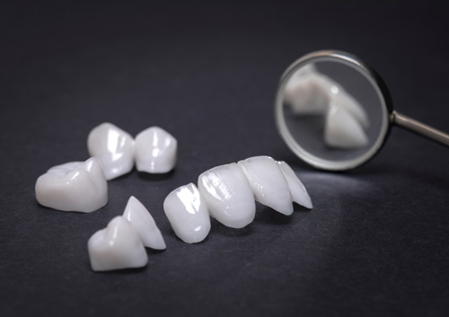 Ceramic veneers