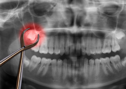 orthodontic tool show wisdom tooth