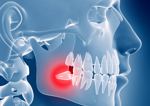 3d rendered illustration of an impacted wisdom tooth
