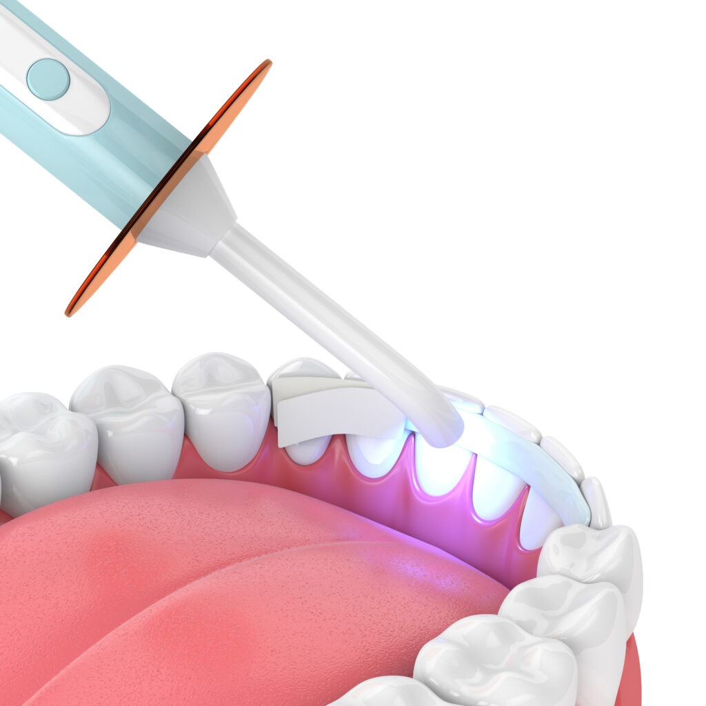 3d render of jaw with dental polymerization lamp and dental fibe