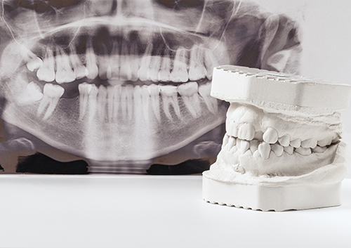Dental casting gypsum model of human jaws with panoramic dental x ray . Crooked teeth and distal bite. Shots were made before treatment with braces.