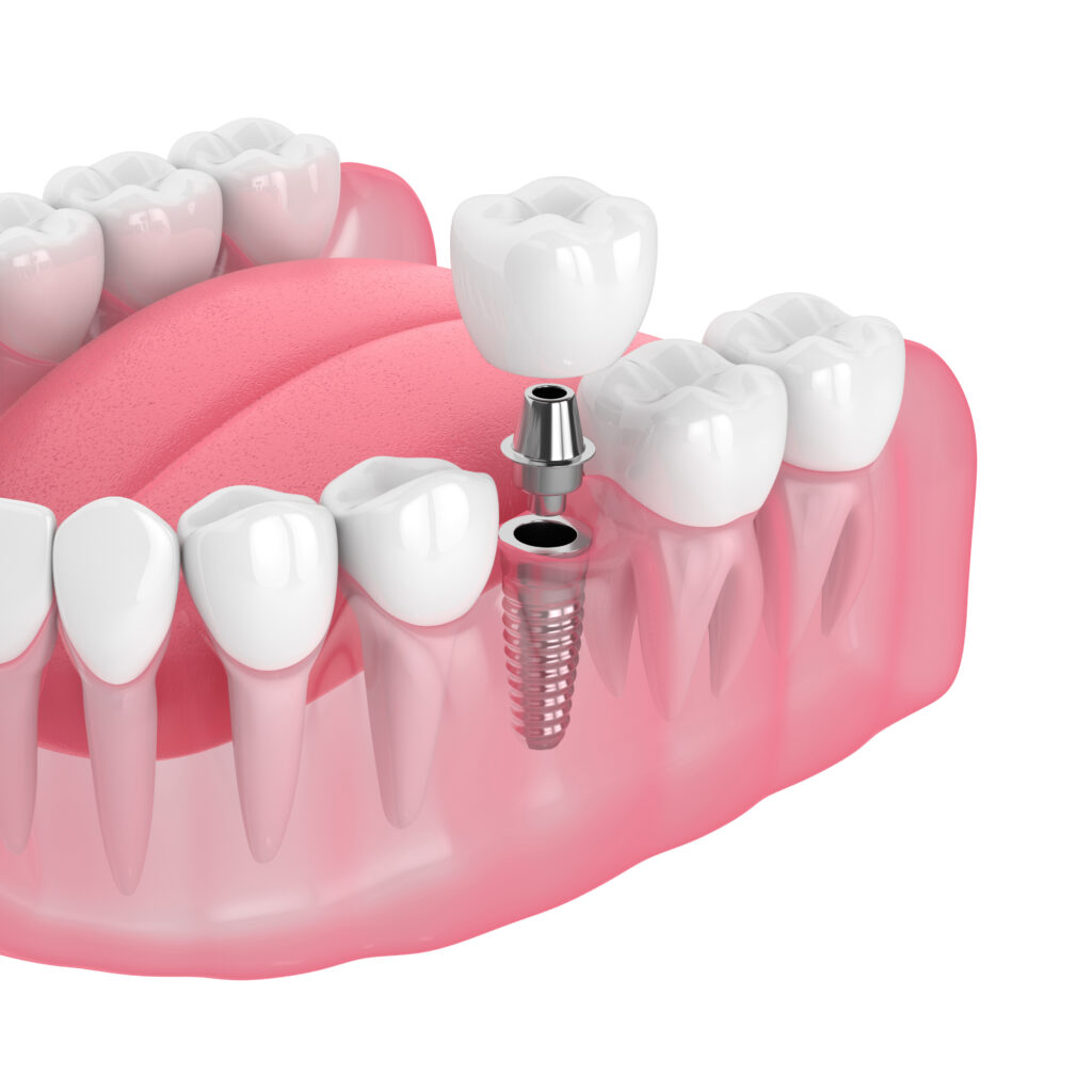 3d render of jaw with dental implant