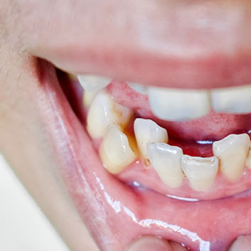 Stacked or overlapping teeth of Asian man. Also called crowded t