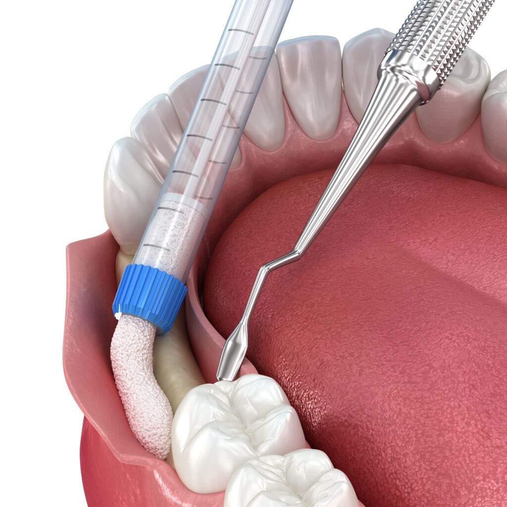 Bone grafting augmentation for tooth implantation. Medically acc