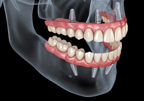Medically accurate 3D illustration of human teeth and dentures