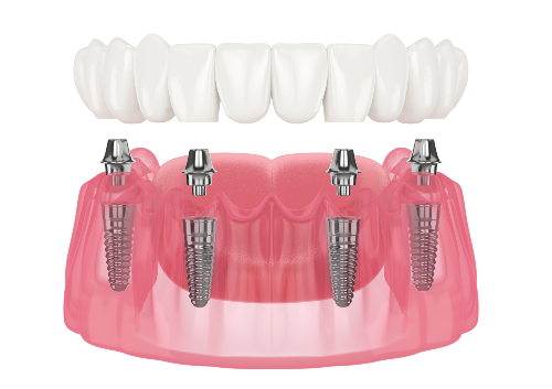 all on 4 dental procedure