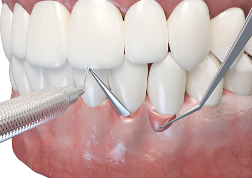 gum graft surgery