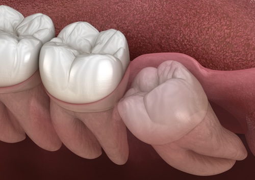 Healthy teeth and wisdom tooth