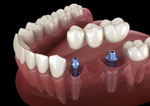 Dental bridge