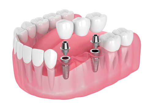 implants supported dental bridge