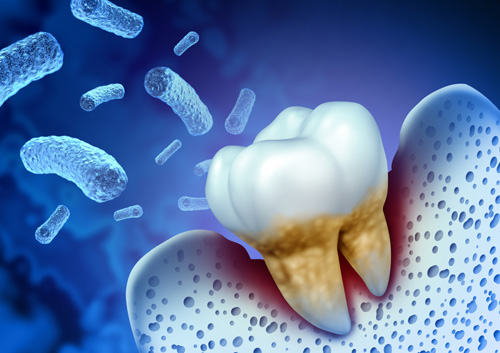 Tooth Bacterial Infection
