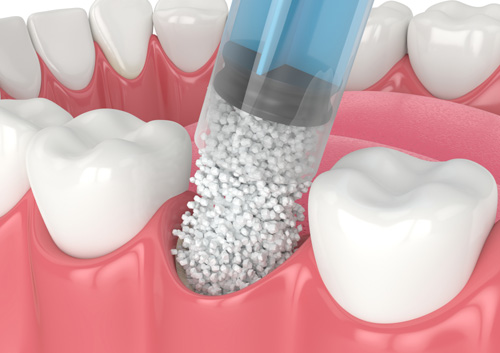 dental bone grafting