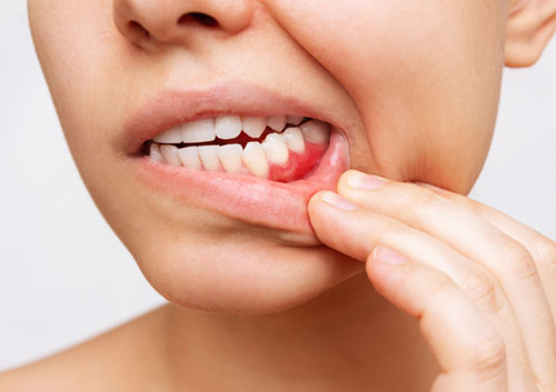 Gum inflammation