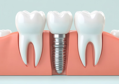 dental implant shown between two natural teeth